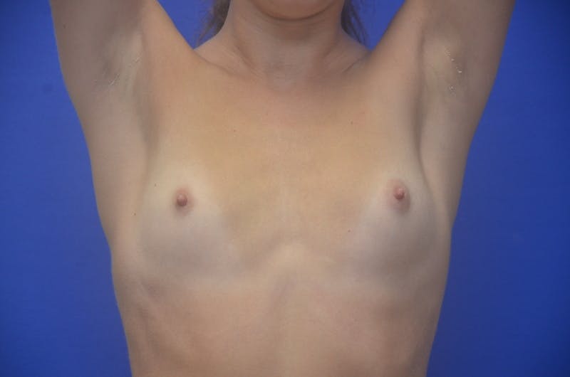 Breast Augmentation Before & After Gallery - Patient 317467 - Image 11
