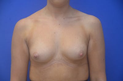 Breast Augmentation Before & After Gallery - Patient 367593 - Image 1