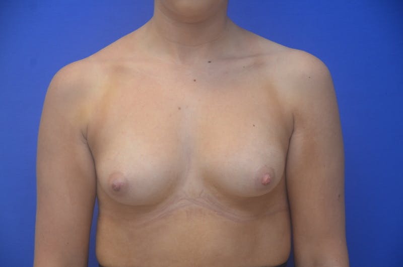Breast Augmentation Before & After Gallery - Patient 367593 - Image 1