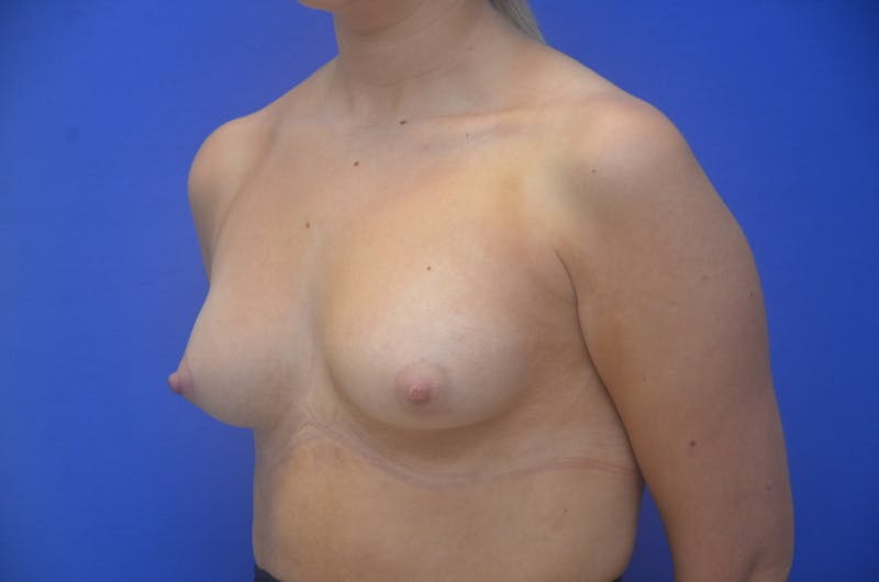 Breast Augmentation Before & After Gallery - Patient 367593 - Image 5