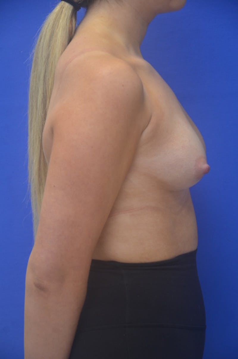 Breast Augmentation Before & After Gallery - Patient 367593 - Image 7