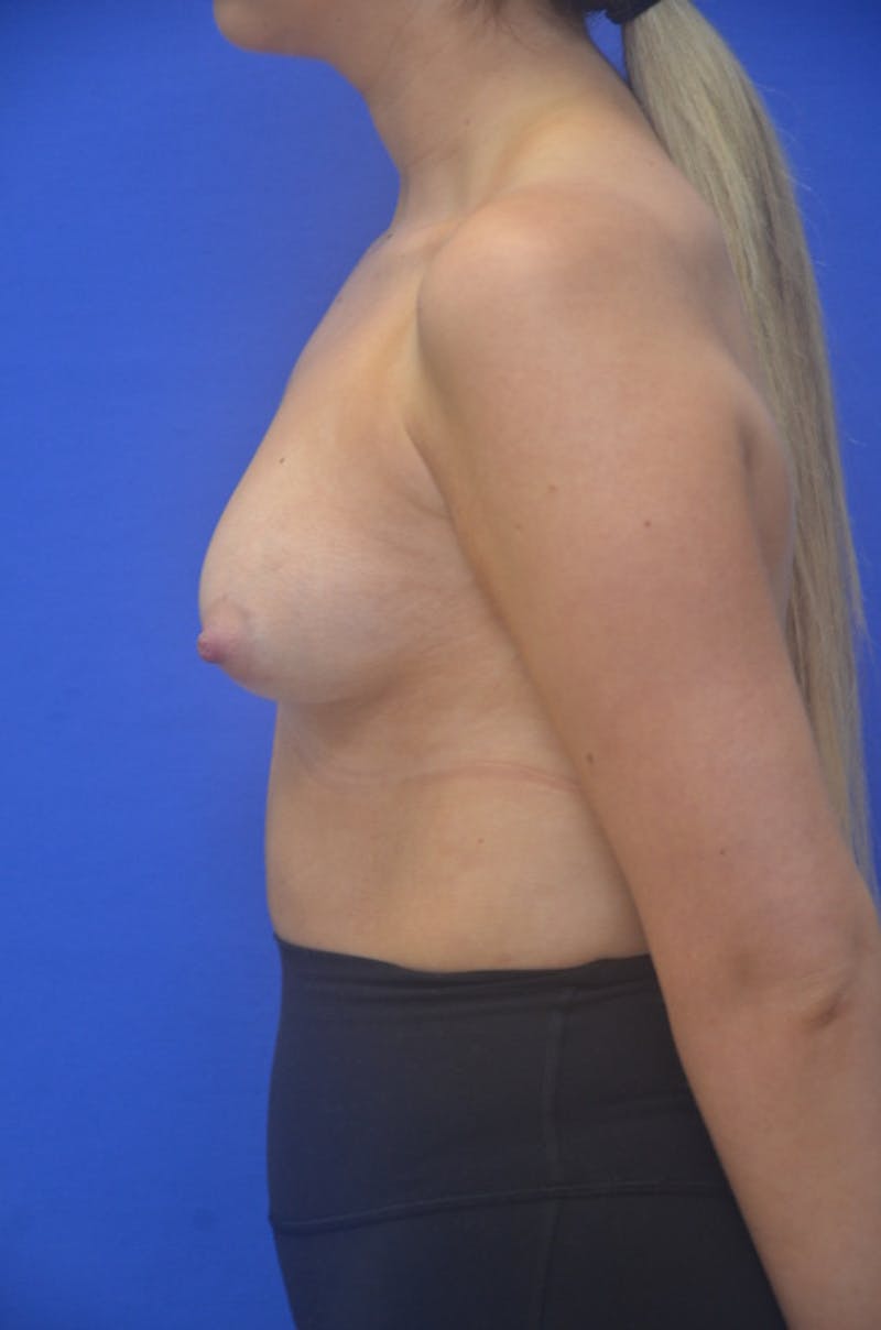 Breast Augmentation Before & After Gallery - Patient 367593 - Image 9