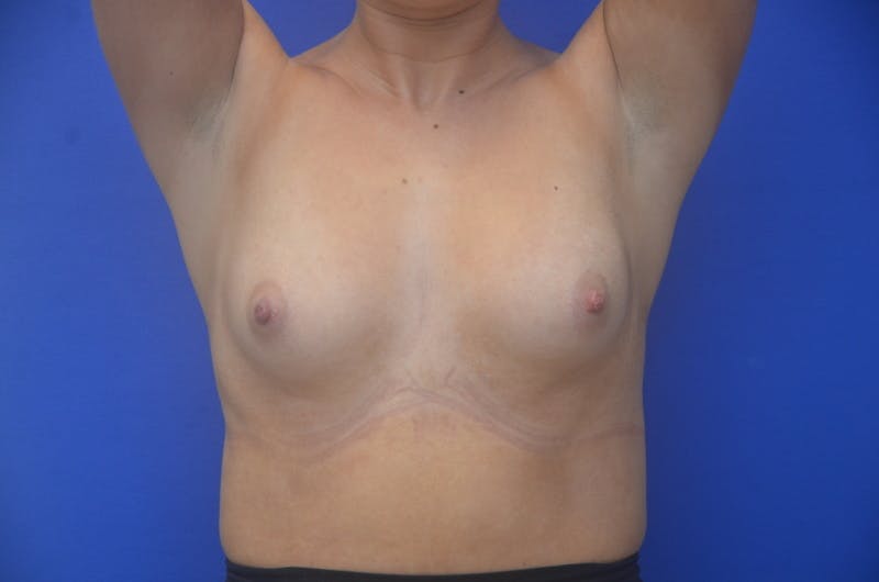Breast Augmentation Before & After Gallery - Patient 367593 - Image 11