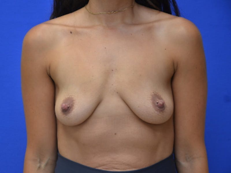 Breast Augmentation Before & After Gallery - Patient 377148 - Image 1