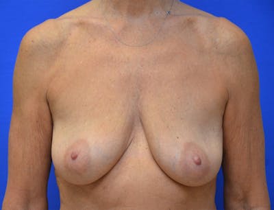 Breast Augmentation Before & After Gallery - Patient 386255 - Image 1