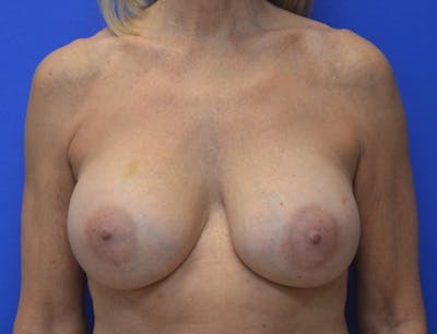 Breast Augmentation Before & After Gallery - Patient 386255 - Image 2