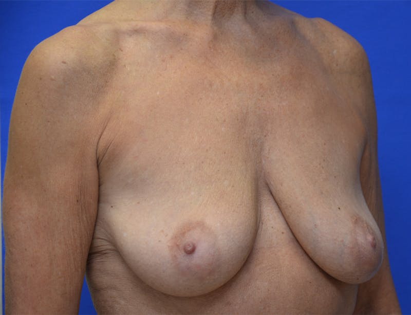 Breast Augmentation Before & After Gallery - Patient 386255 - Image 3