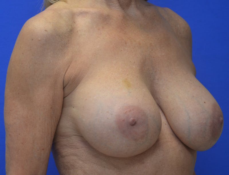 Breast Augmentation Before & After Gallery - Patient 386255 - Image 4