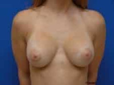 Breast Augmentation Before & After Gallery - Patient 228436 - Image 2