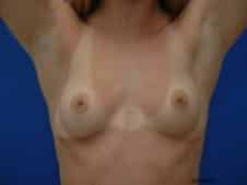 Breast Augmentation Before & After Gallery - Patient 228436 - Image 3