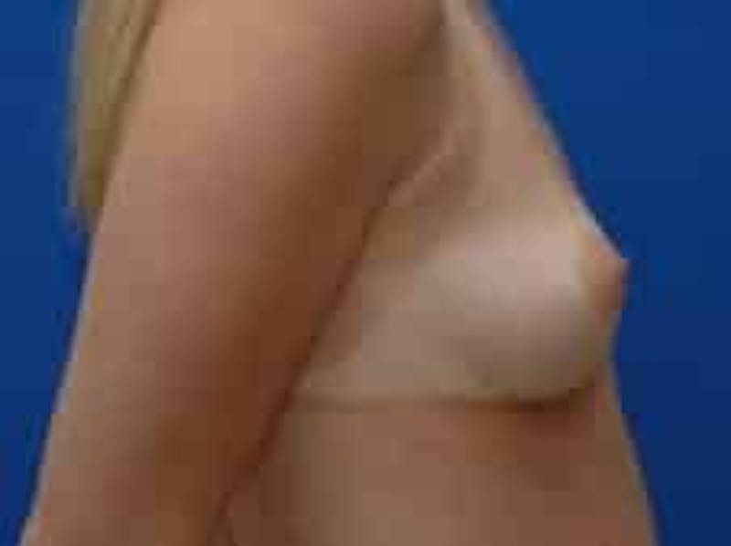 Breast Augmentation Before & After Gallery - Patient 228436 - Image 5