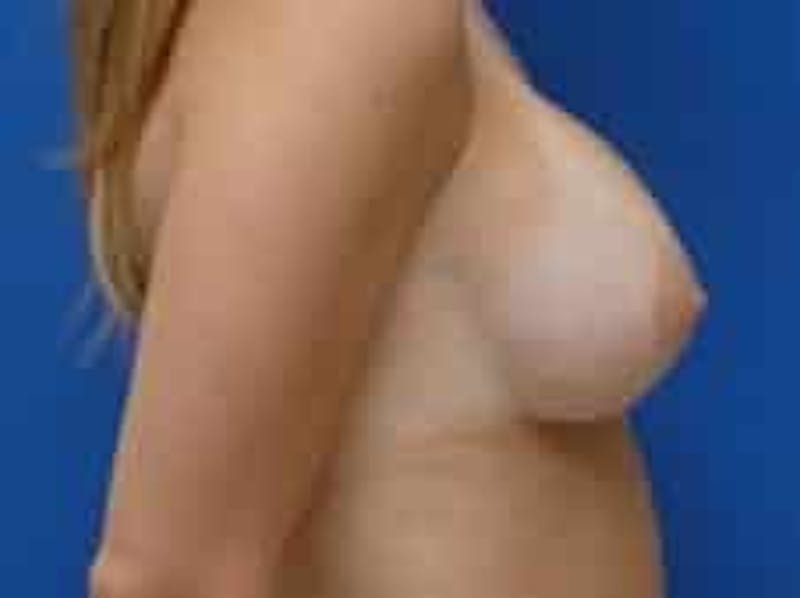 Breast Augmentation Before & After Gallery - Patient 228436 - Image 6