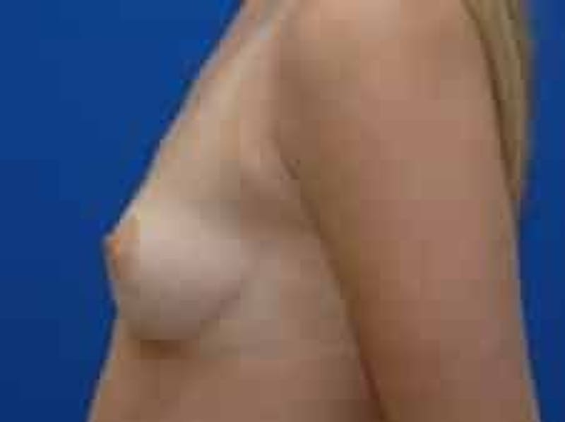 Breast Augmentation Before & After Gallery - Patient 228436 - Image 9