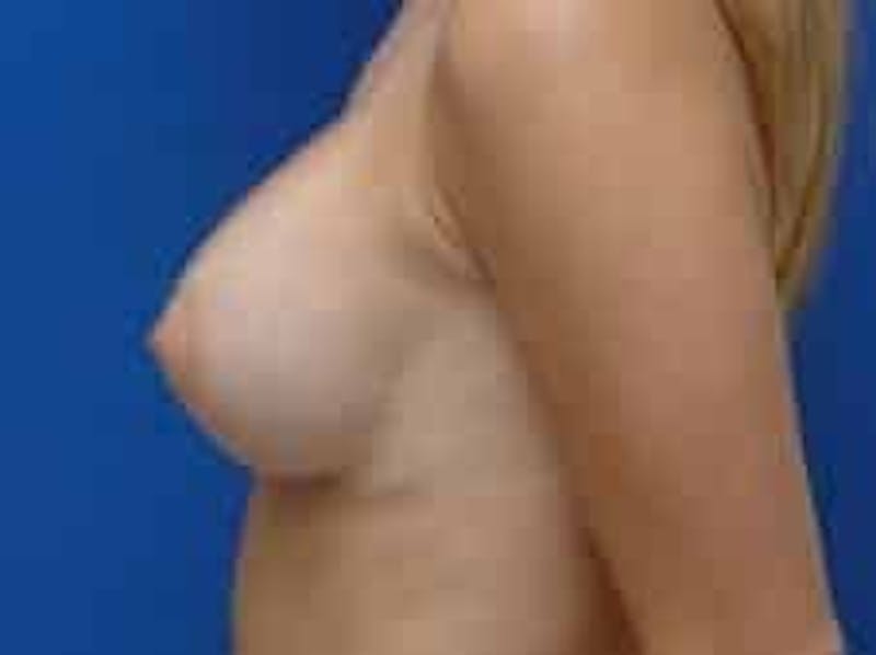 Breast Augmentation Before & After Gallery - Patient 228436 - Image 10
