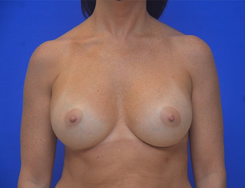 Breast Augmentation Before & After Gallery - Patient 366720 - Image 2