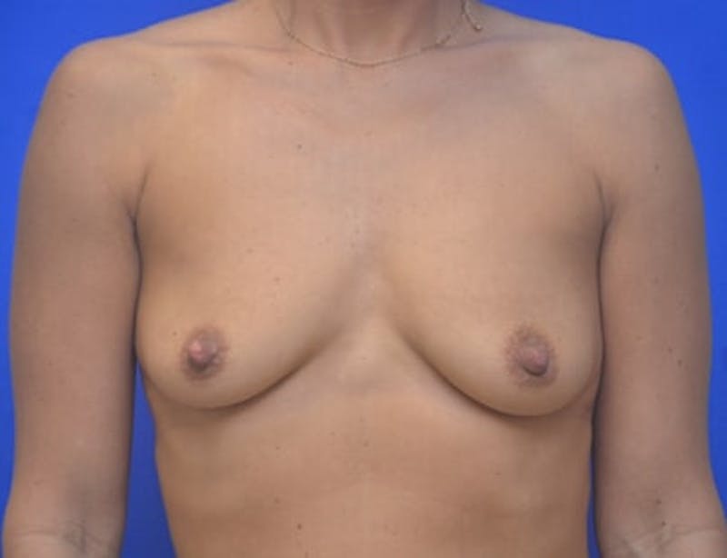 Breast Augmentation Before & After Gallery - Patient 350315 - Image 1