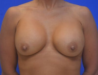 Breast Augmentation Before & After Gallery - Patient 350315 - Image 2