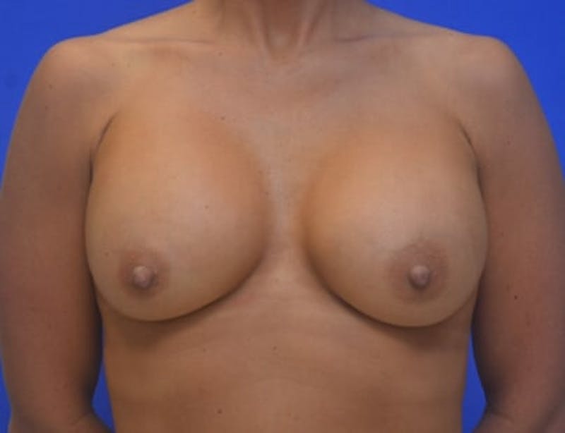 Breast Augmentation Before & After Gallery - Patient 350315 - Image 2