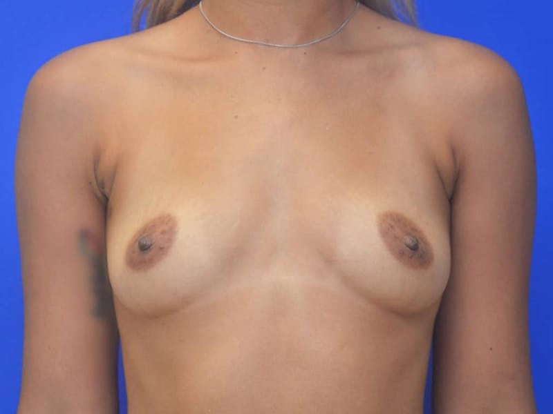 Breast Augmentation Before & After Gallery - Patient 239025 - Image 1