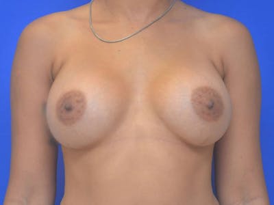 Breast Augmentation Before & After Gallery - Patient 239025 - Image 2