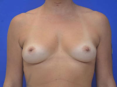 Breast Augmentation Before & After Gallery - Patient 388577 - Image 1
