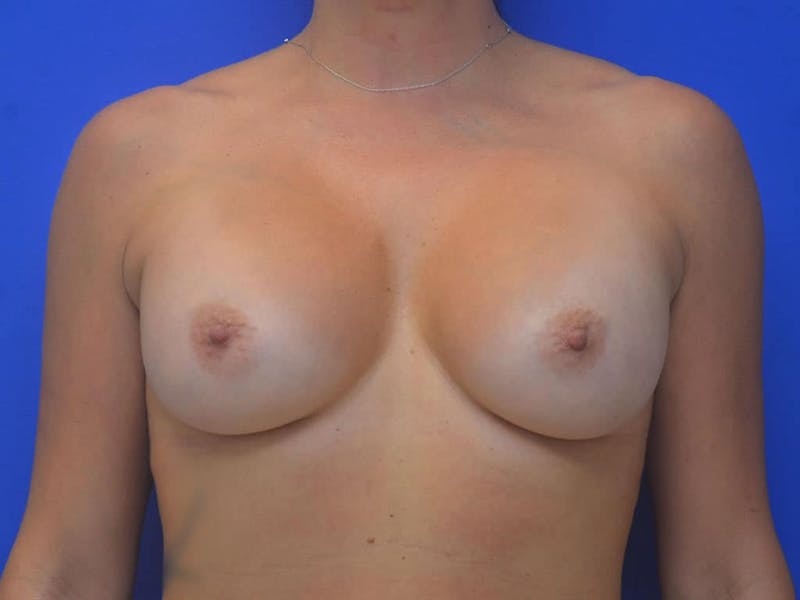 Breast Augmentation Before & After Gallery - Patient 388577 - Image 2