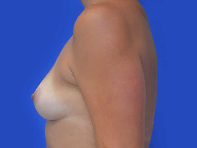 Breast Augmentation Before & After Gallery - Patient 388577 - Image 3
