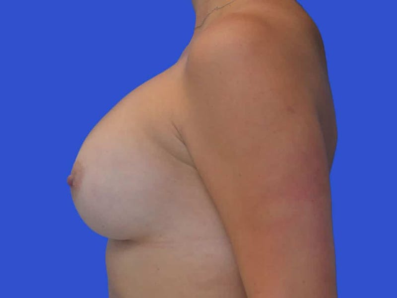 Breast Augmentation Before & After Gallery - Patient 388577 - Image 4