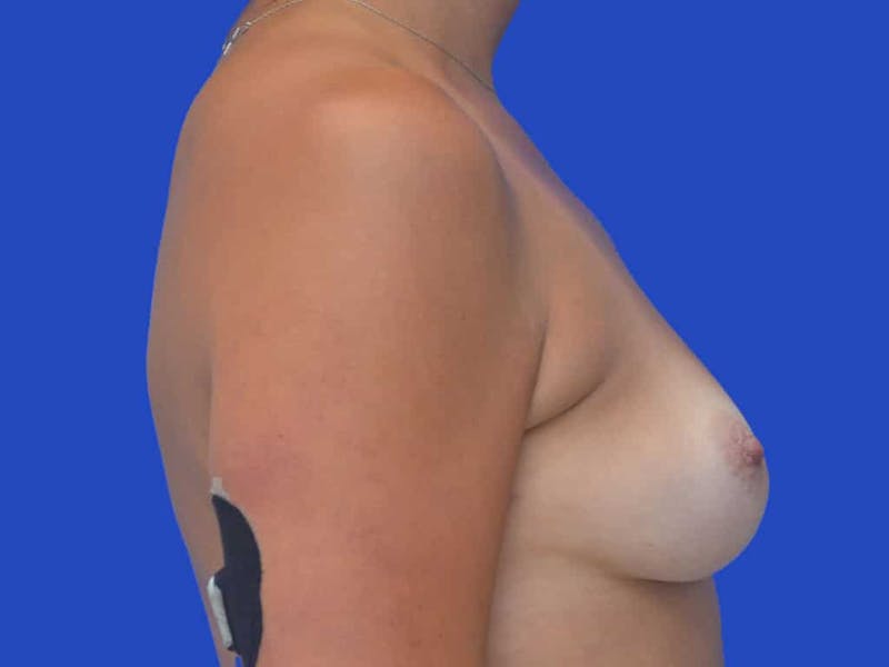 Breast Augmentation Before & After Gallery - Patient 388577 - Image 5