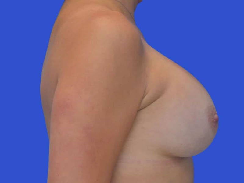 Breast Augmentation Before & After Gallery - Patient 388577 - Image 6