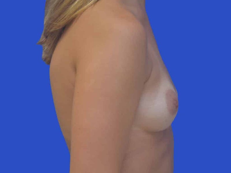 Breast Augmentation Before & After Gallery - Patient 746220 - Image 5