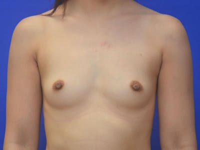 Breast Augmentation Before & After Gallery - Patient 215056 - Image 1