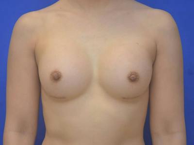Breast Augmentation Before & After Gallery - Patient 215056 - Image 2