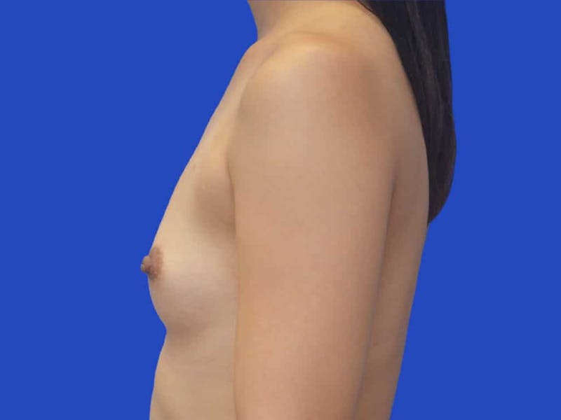 Breast Augmentation Before & After Gallery - Patient 215056 - Image 3