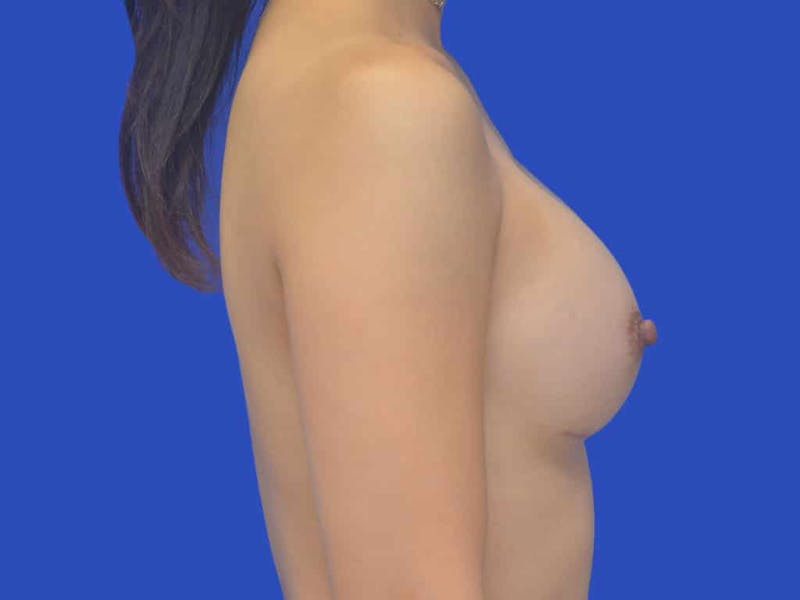 Breast Augmentation Before & After Gallery - Patient 215056 - Image 6