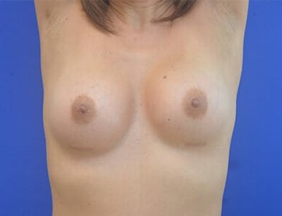 Breast Augmentation Before & After Gallery - Patient 152366 - Image 2
