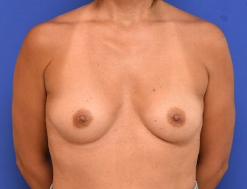 Breast Augmentation Before & After Gallery - Patient 152366 - Image 3