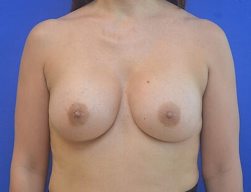 Breast Augmentation Before & After Gallery - Patient 152366 - Image 4