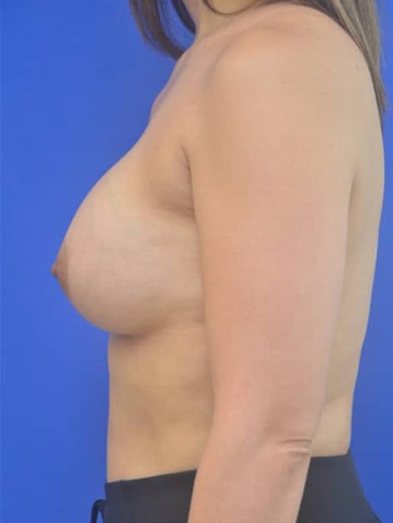 Breast Augmentation Before & After Gallery - Patient 152366 - Image 6