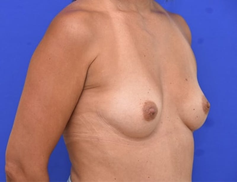 Breast Augmentation Before & After Gallery - Patient 152366 - Image 9