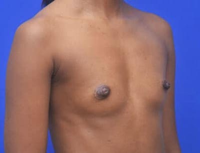 Breast Augmentation Before & After Gallery - Patient 241859 - Image 1