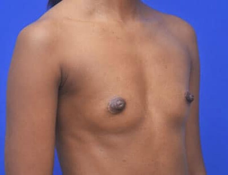 Breast Augmentation Before & After Gallery - Patient 241859 - Image 1