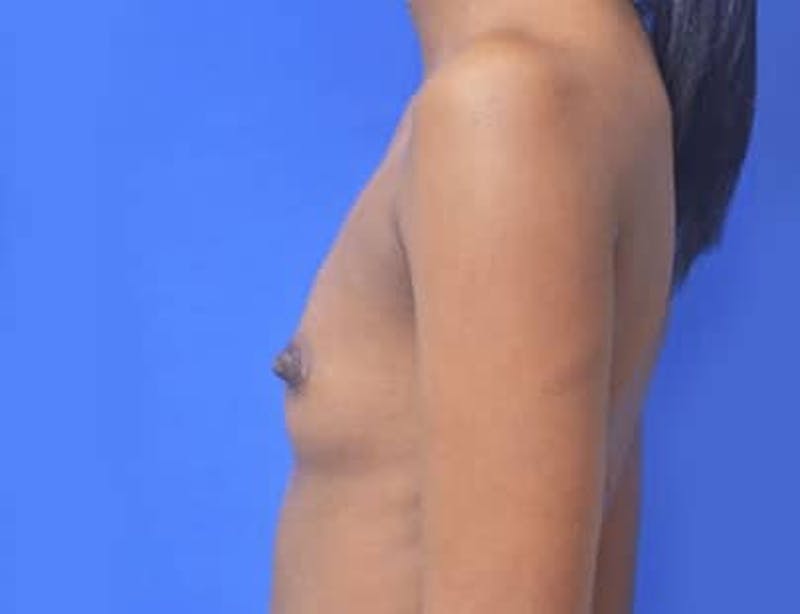 Breast Augmentation Before & After Gallery - Patient 241859 - Image 3