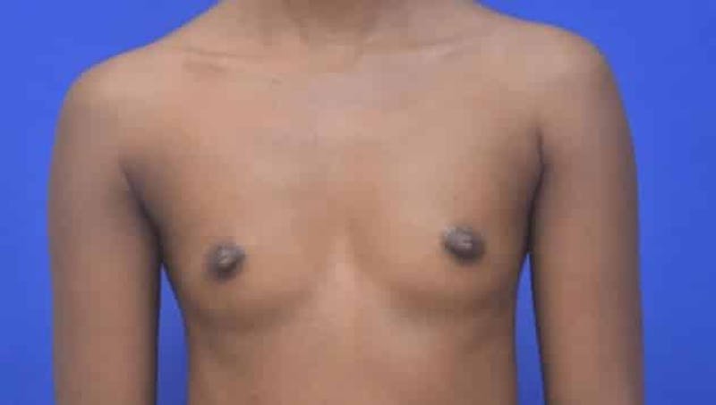 Breast Augmentation Before & After Gallery - Patient 241859 - Image 5