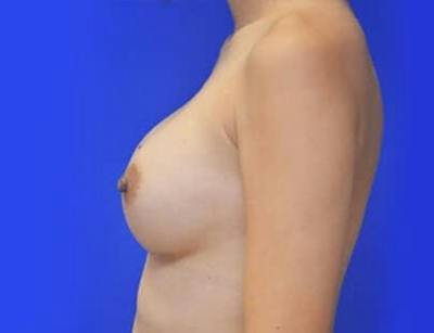 Breast Augmentation Before & After Gallery - Patient 231121 - Image 2