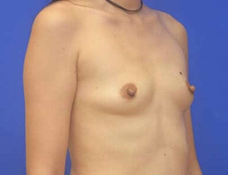Breast Augmentation Before & After Gallery - Patient 231121 - Image 3
