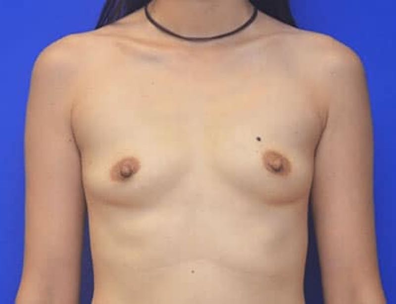 Breast Augmentation Before & After Gallery - Patient 231121 - Image 5