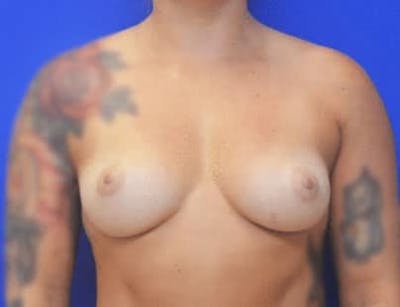 Breast Augmentation Before & After Gallery - Patient 166329 - Image 1