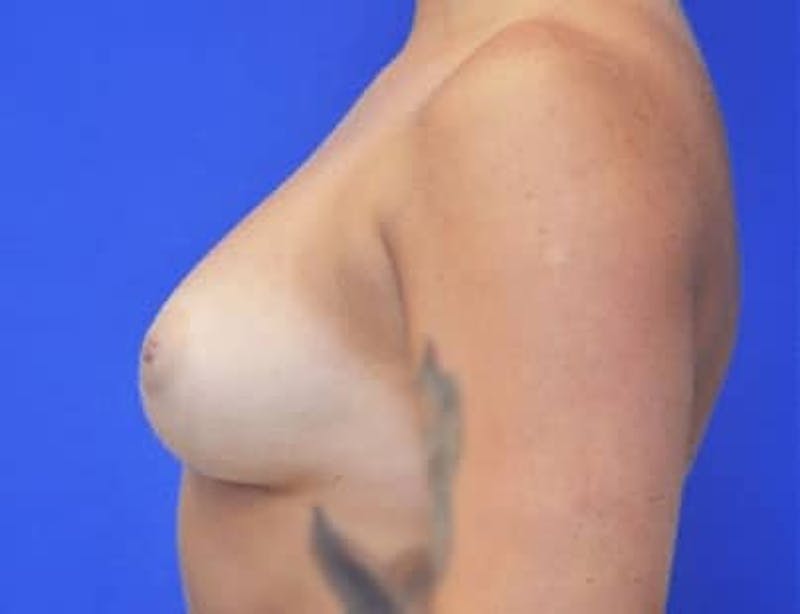 Breast Augmentation Before & After Gallery - Patient 166329 - Image 3
