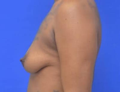 Breast Augmentation Before & After Gallery - Patient 171758 - Image 1